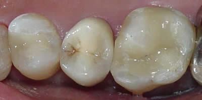 Teeth repaired with Gilbert porcelain crowns