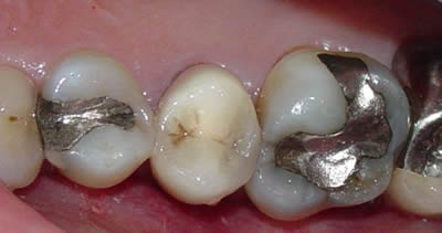 Broken mercury amalgam fillings needing repair by porcelain crowns