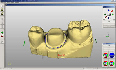 Porcelain crown design by CEREC