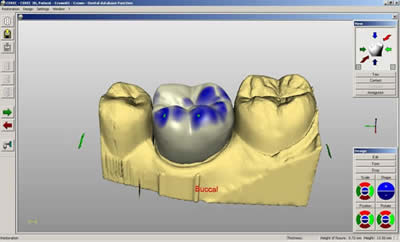 Porcelain crown design by CEREC