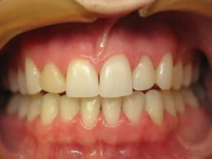 Before Mesa cosmetic dentist porcelain veneers