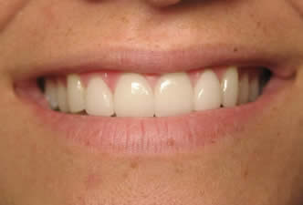 After Mesa cosmetic dentistry veneers