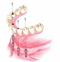 Implant dentures